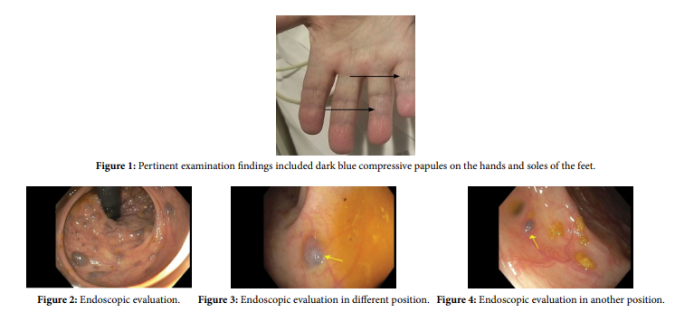 The Curious Case of Leaky Blue Blebs: A Rare Image of Blue Rubber Bleb Nevus Syndrome