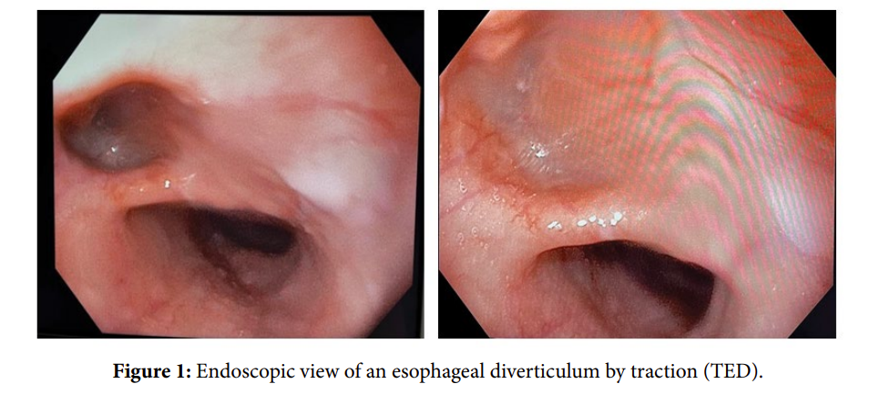 Unusual Cause of Dysphagia: A Traction Esophageal Diverticulum