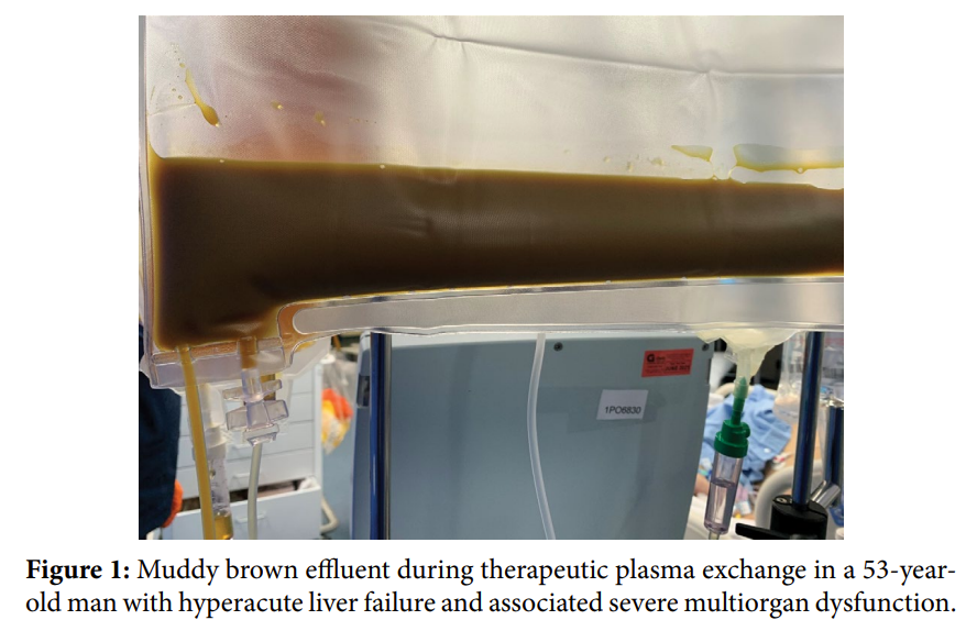 Plasma Colour in Acute Liver Failure