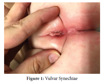 Vulvar Synechiae - Prepubertal Alert