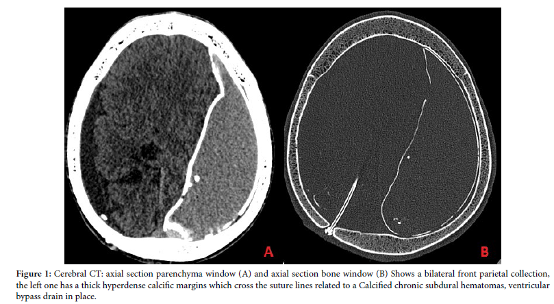 Chronic Calcified Subdural Hematoma