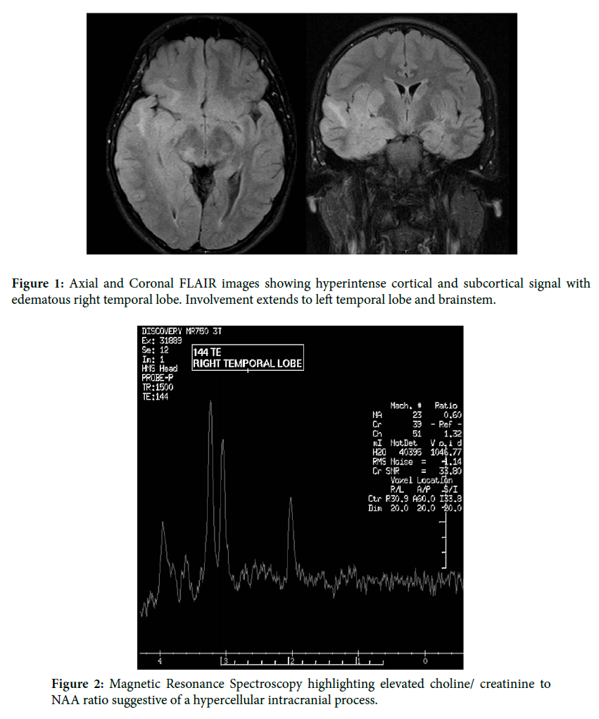 Clinical Neuroimage: Pediatric Gliomatosis Cerebri