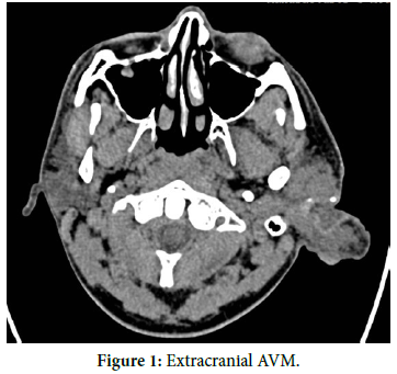 A Case of External Ear and Submandibular Extracranial AVM