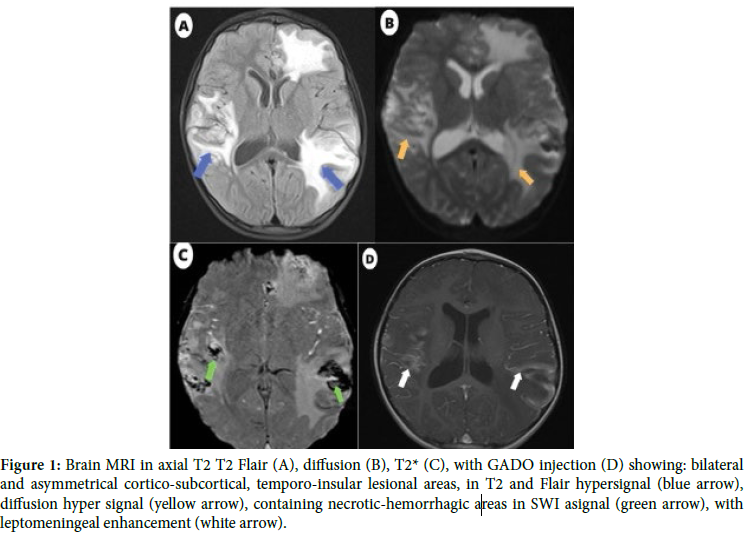 Herpetic Encephalopathy in Children: A Case Report.
