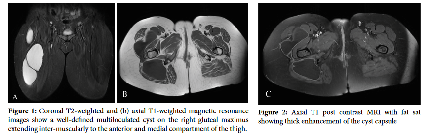 Rare Origin of a Soft Tissue Cystic Mass of the Thigh: Muscular Hydatidosis