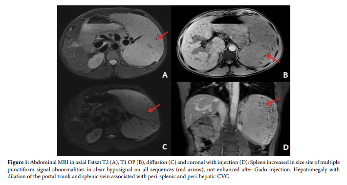 Gamna-Gandy Bodies: A Case Report