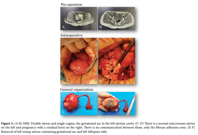 Type II Residual Horn Uterine Pregnancy Complicated with Unilateral Kidney Deficiency: A Case Report