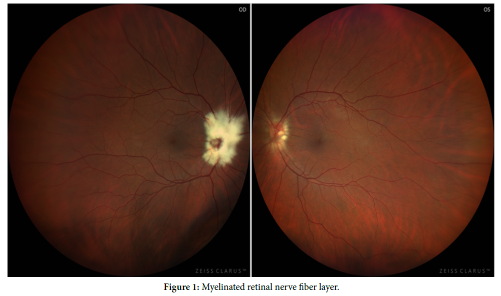 Myelinated Retinal Nerve Fiber Layer (MNFL)