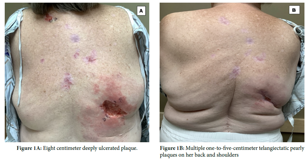 Non-surgical Treatment of Large Ulcerated Basal Cell Carcinoma