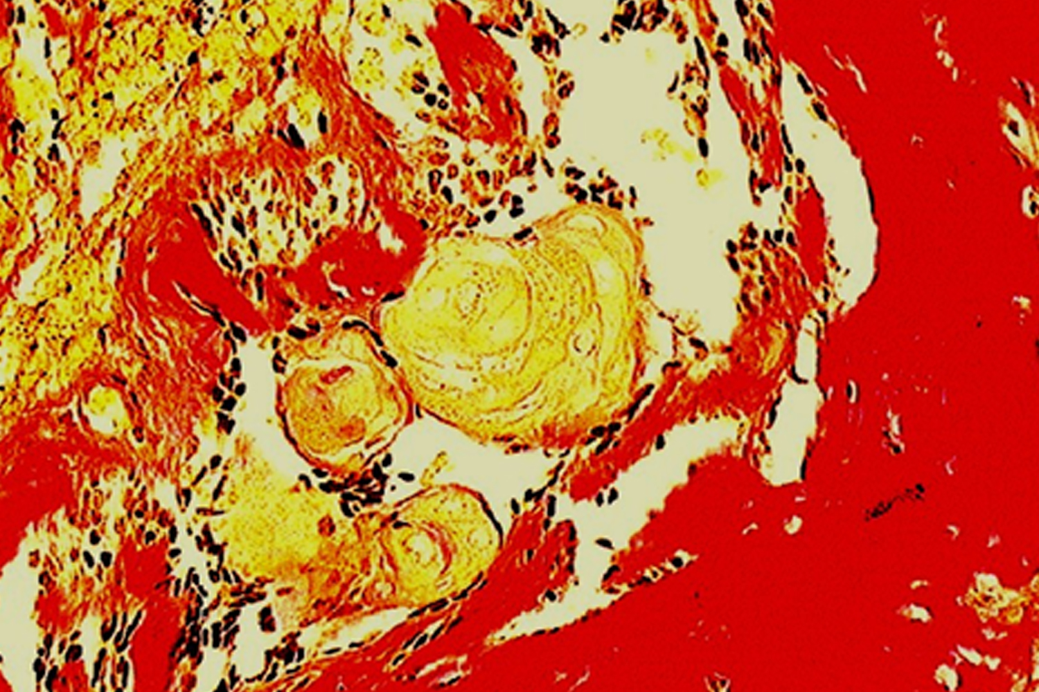 Van Gieson stain for Odontogenic tumor