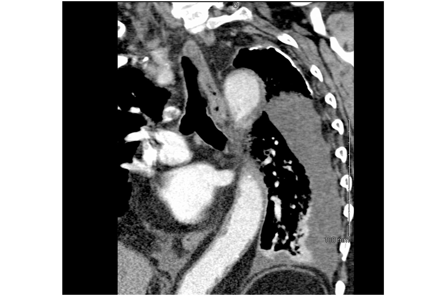 Incidental Finding Of Mesothelioma After A Motor Vehicle Accident