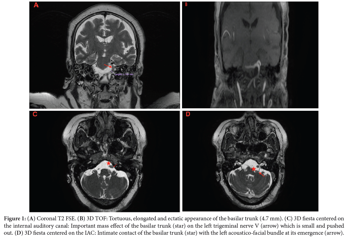 Mega-Dolicho Vertebrobasilar System: An Unusual Cause of Cranial Pair Damage