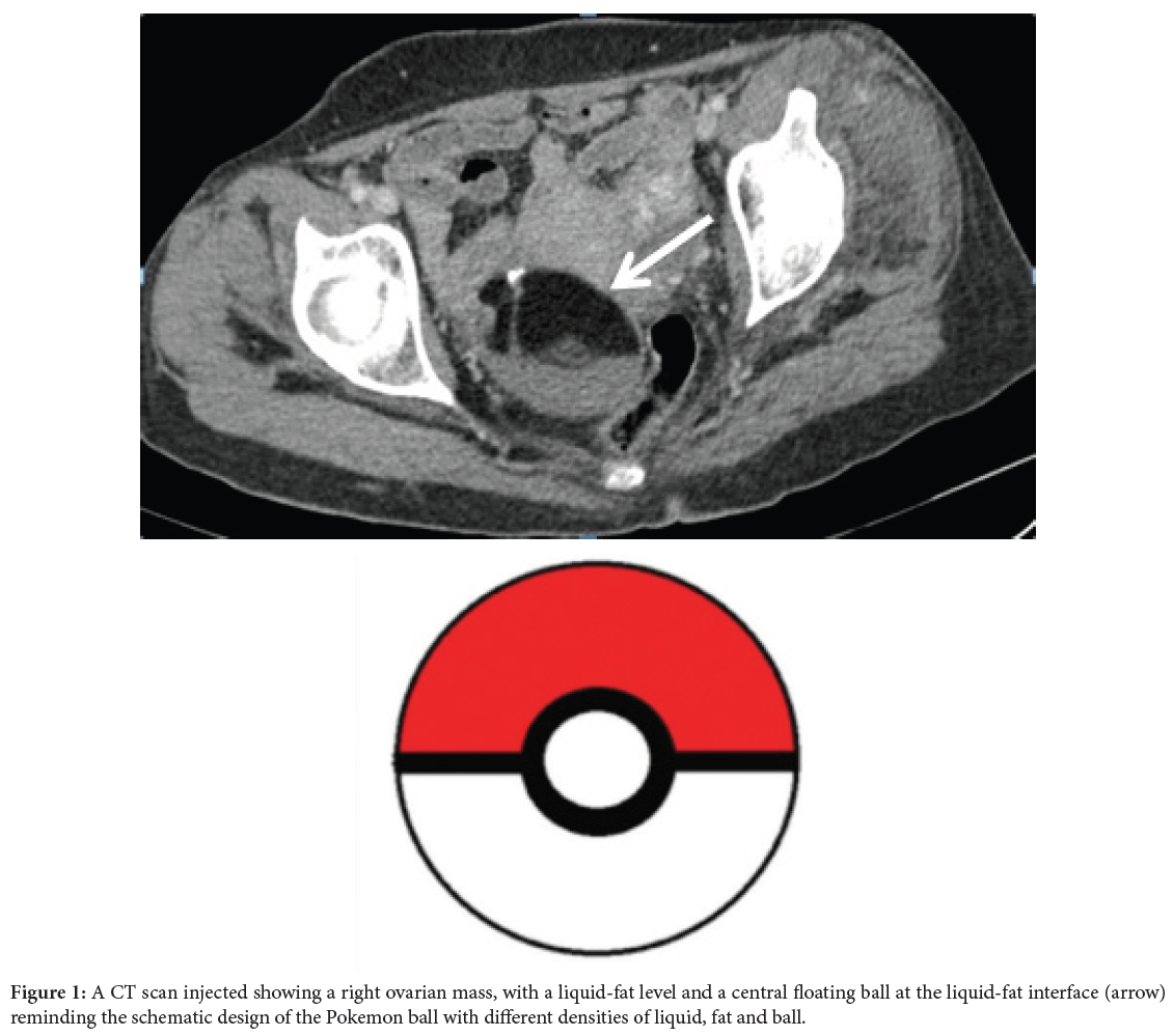 Poke Ball Sign: Mature Cystic Teratoma