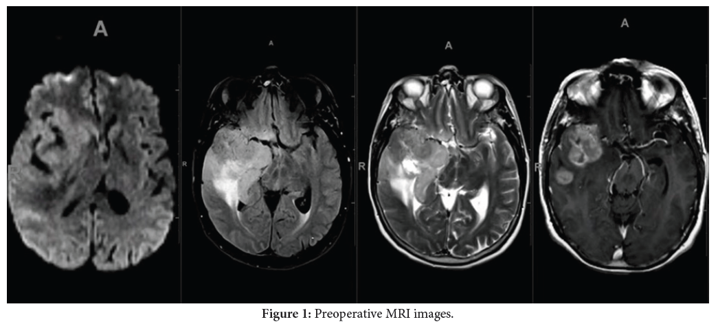 Advanced MRI Techniques for Diagnosis and Monitoring of Glioblastoma in Adults: A Comprehensive Overview