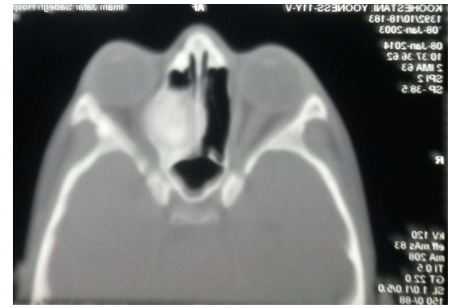 Ossifying Fibroma In Left Ethmoidal Sinus In 11years Old Iranian Boy
