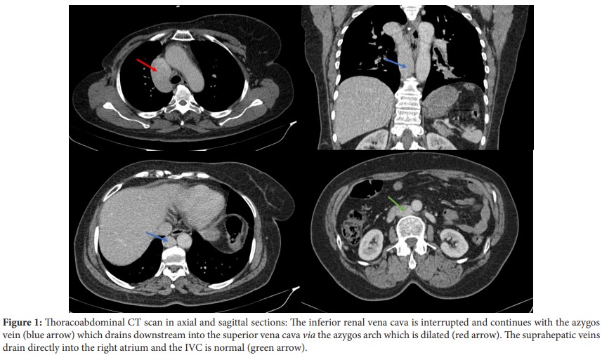 Interruption of VCI with Azygos Continuation