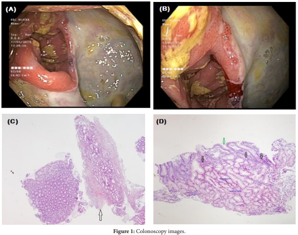 An Unusual Case of Gastric Heterotopia in the Ascending Colon