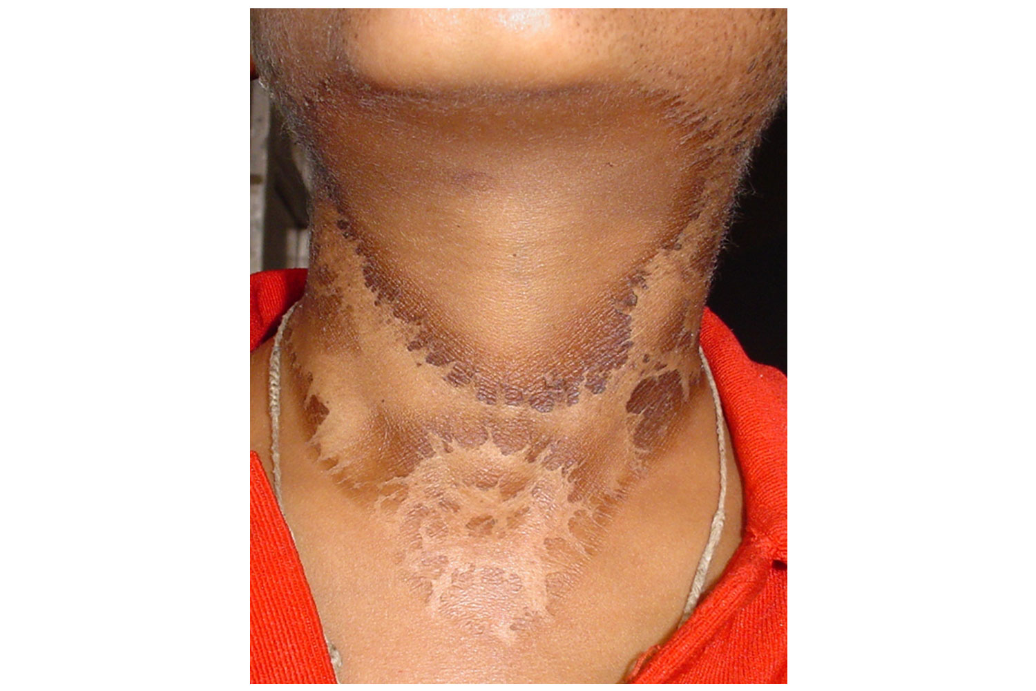 A Case Of Classical Casal's Necklace In An 8 Year Old Boy