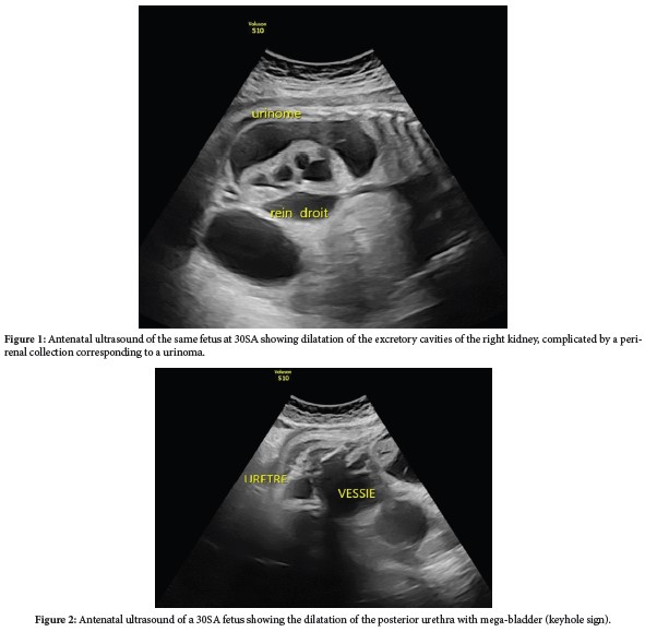 Antenatal Urinoma Revealing a Posterior Urethral Valve