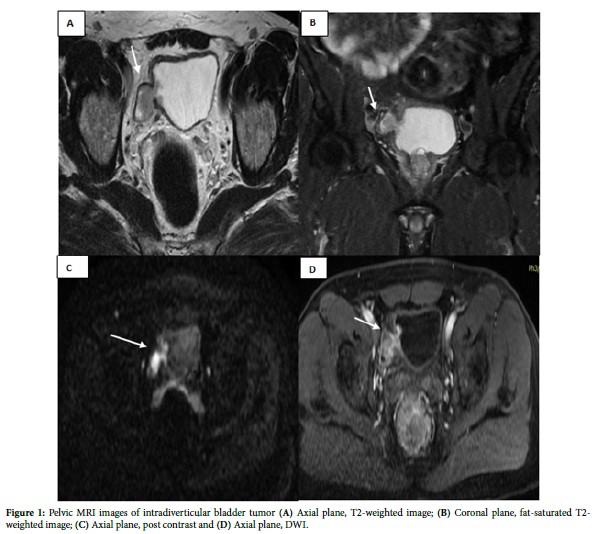 A Rare yet Classic Case: Intradiverticular Bladder Tumor