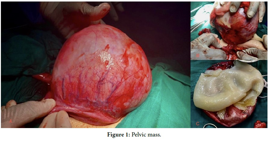 Pelvic Hydatid Disease: Ultrasound is enough