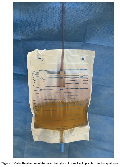 What does a purple discoloration of urine mean ?