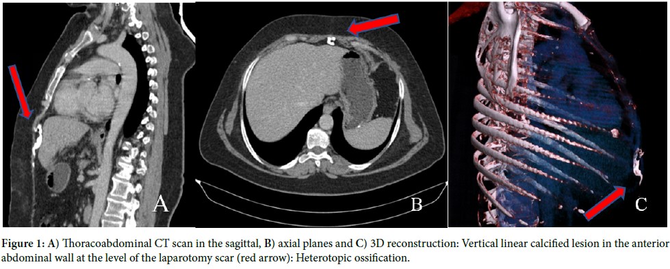 Heterotopic ossification in a midline laparotomy scar