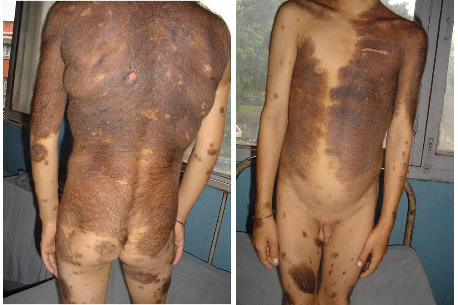 Giant Congenital Melanocytic Naevus With Nodularity And Anetoderma In An Adolescent