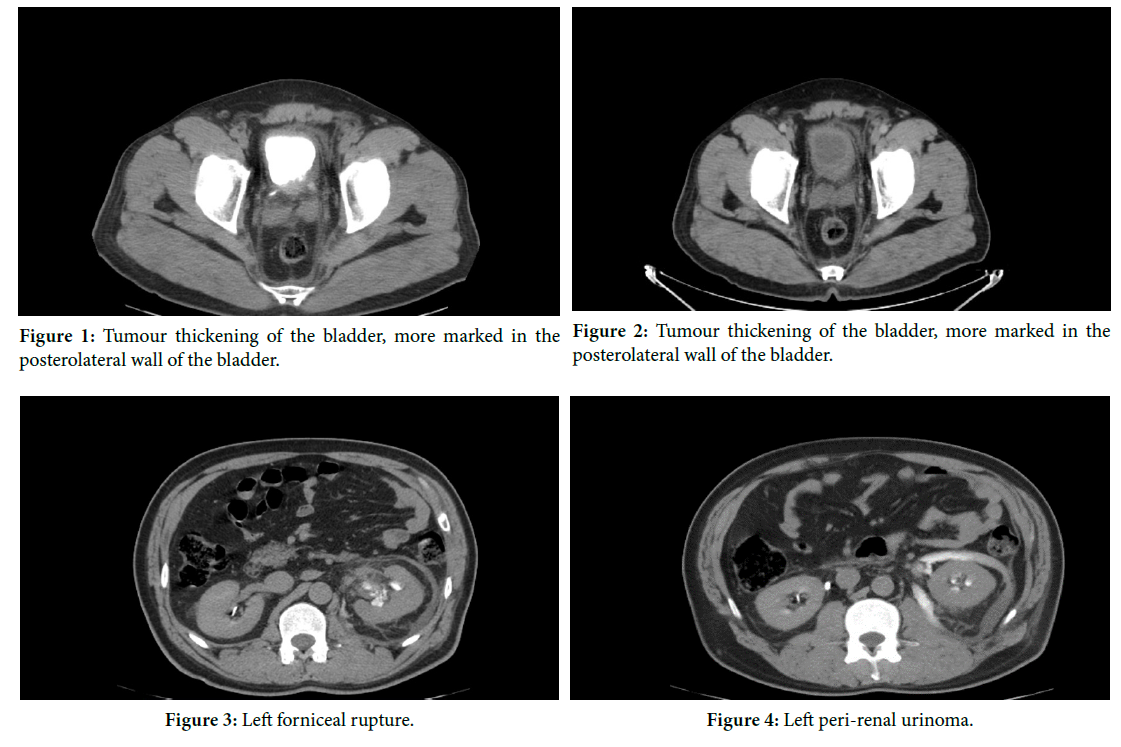 Perirenal urinoma on rupture of the fornix secondary to a bladder tumour
