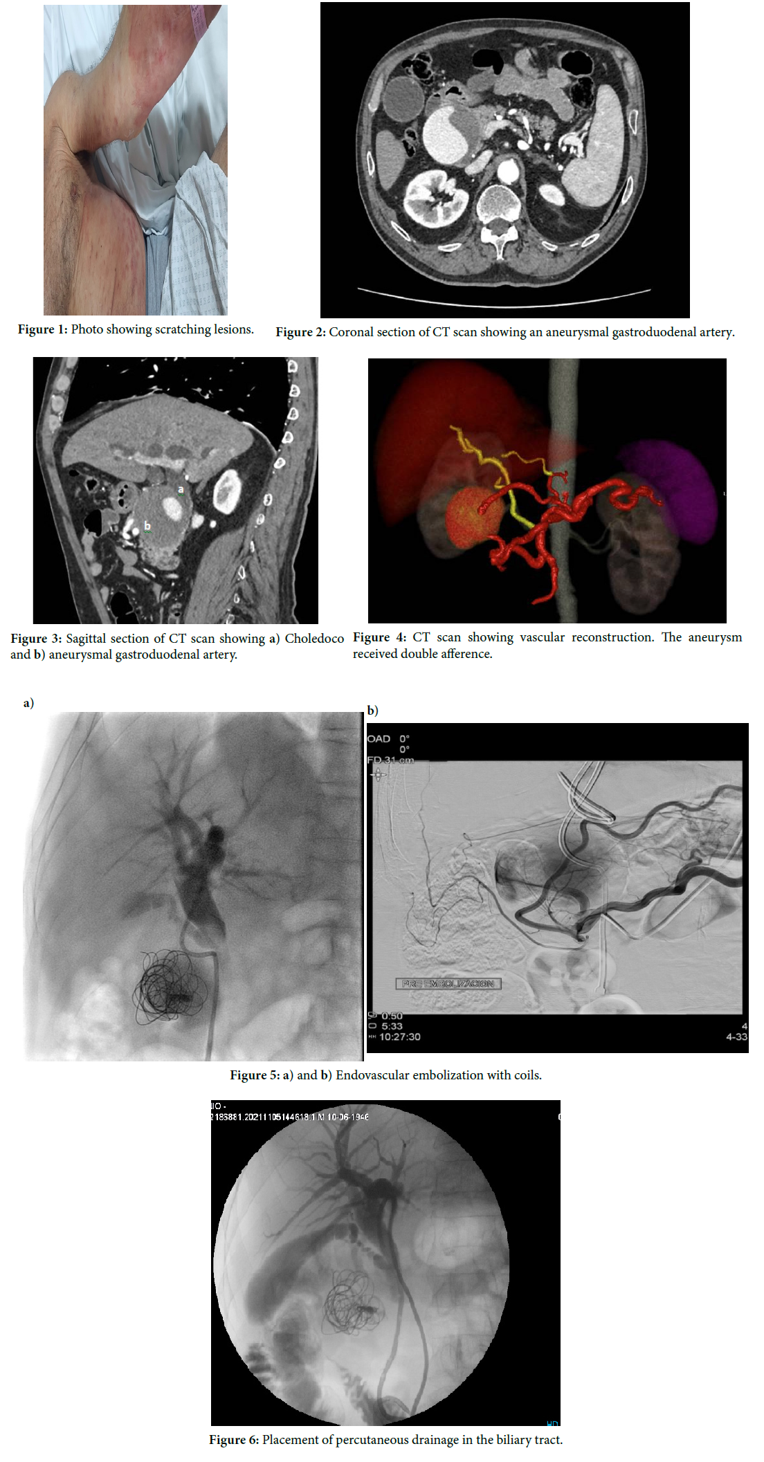 Minimally Invasive Management of Gastro Duodenal Aneurism