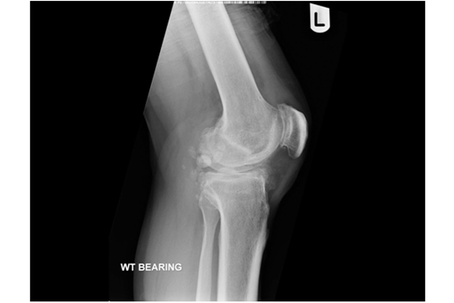 Synovial Chondromatosis