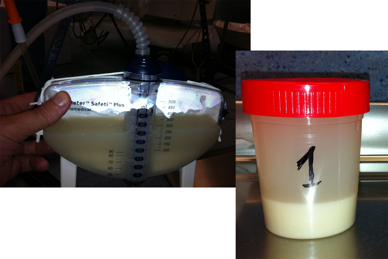 Bronchoalveolar lavage fluid of a patient