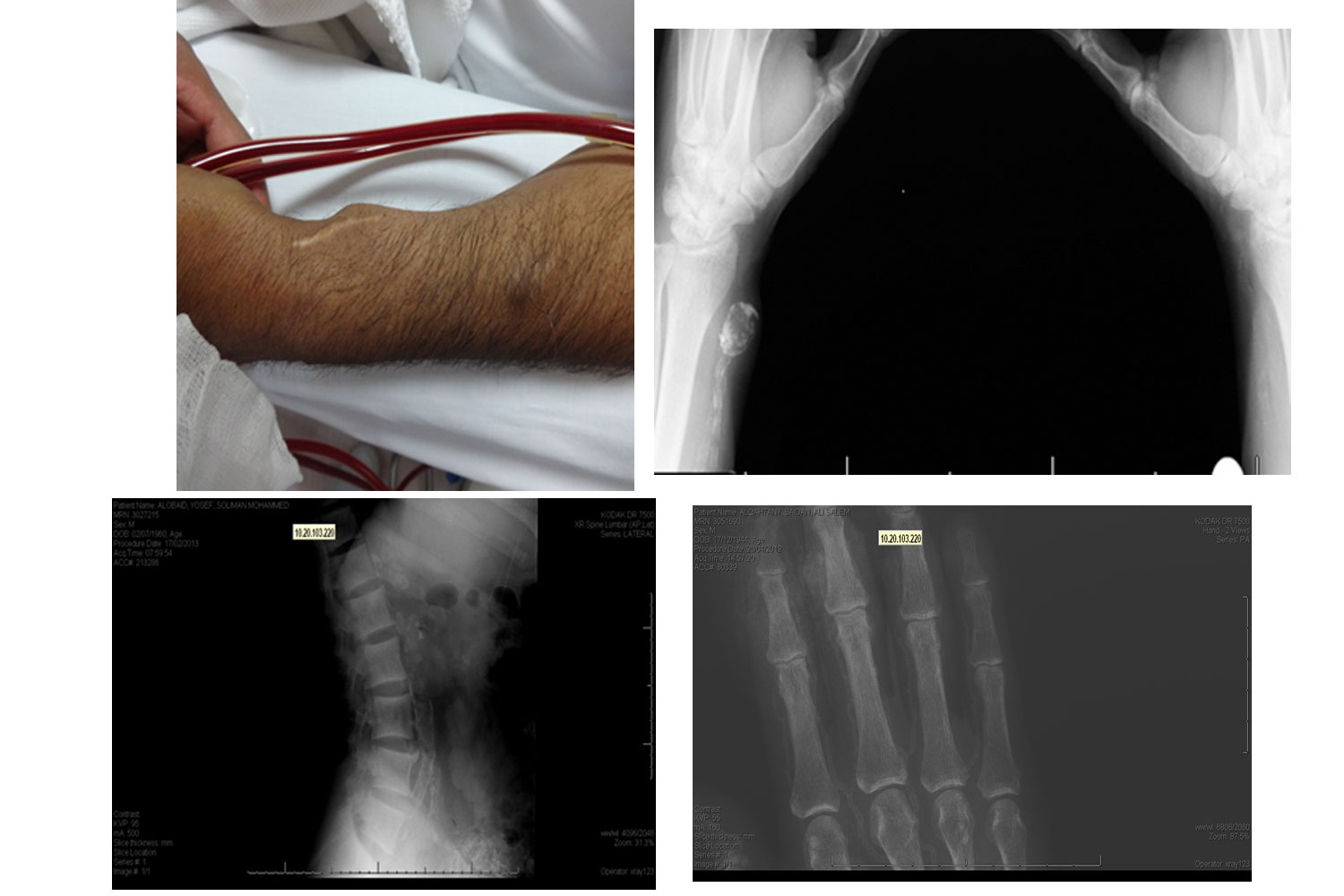 Vascular Calcificación in Dialysis-Treated End-Stage Renal Disease