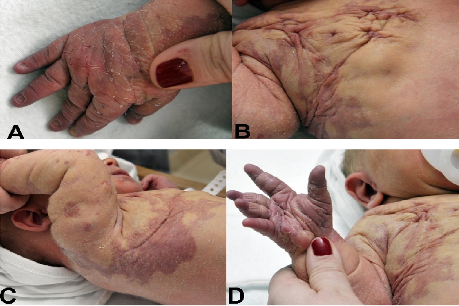 A Newborn with Klippel-Trénaunay Syndrome