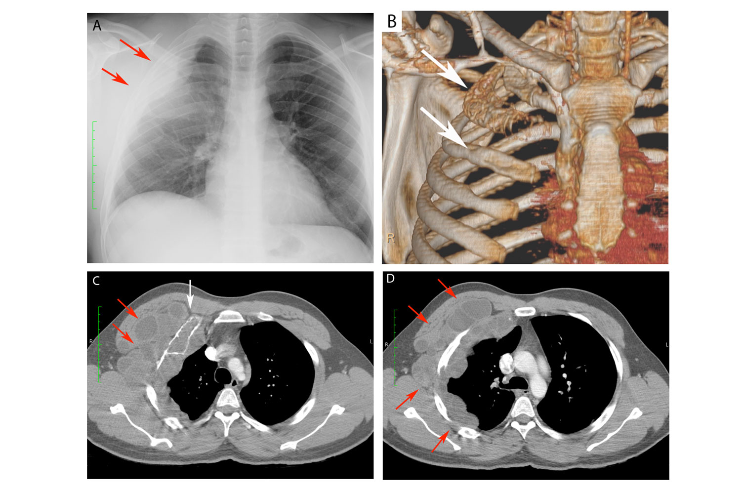 Extensive Extra-Pulmonary Chest Wall Hydatidosis