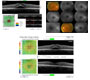 Central Serous Chorioretinopathy