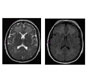 Magnetic Resonance Imaging Of The Brain In Methane Gas Intoxication