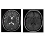 Magnetic Resonance Imaging Of The Head In Persistent HIV-associated Cryptococcal Meningitis Immune Reconstitution Inflammatory Syndrome