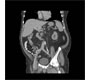 Para-Prosthetic Enteric Fistula Following Aorto-Bifemoral Bypass Surgery