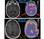 PET and MRI Neuroimaging in Posterior Cortical Atrophy: A Degenerative Disorder Most Commonly Associated with Alzheimer’s disease Pathology