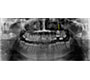 Secondary Retention Of Permanent Left First Maxillary Molar