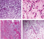 Myxoid Leiomyosarcoma of the Uterus