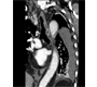 Incidental Finding of Mesothelioma after a Motor Vehicle Accident