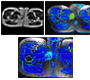 Advanced Magnetic Resonance Imaging in Soft Tissue Sarcomas