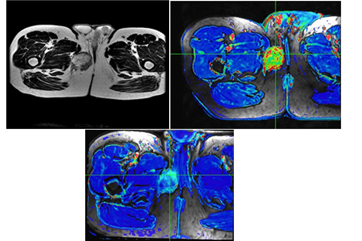Advanced Magnetic Resonance Imaging in Soft Tissue Sarcomas