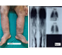 Primary Lymphedema