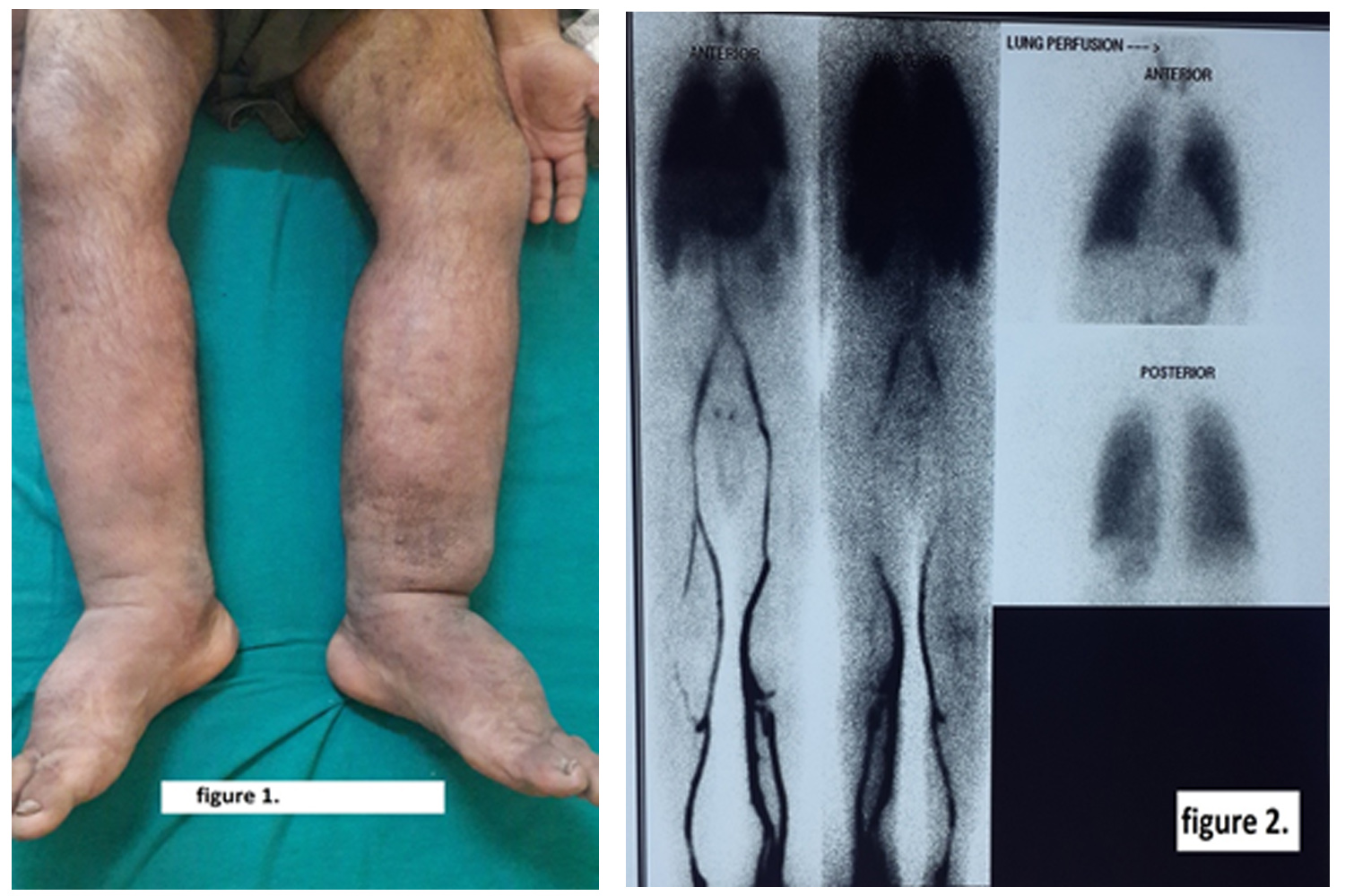 Primary Lymphedema