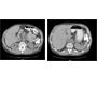 Hereditary Hemochromatosis and Hyperdense Liver by CT Scan