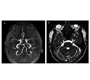 Superior Cerebellar Artery Compressing the Trigeminal Nerve