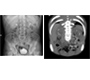 Cacchi- Ricci Disease